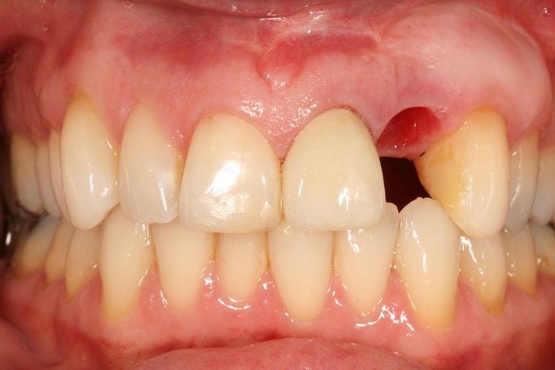 Before image of mouth missing a tooth