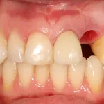 Before image of mouth missing a tooth