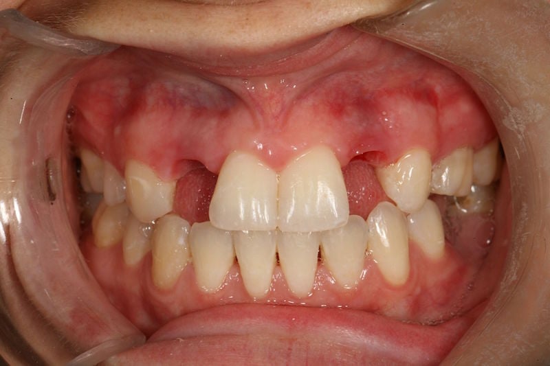 Before image of a mouth missing two teeth