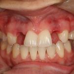 Before image of a mouth missing two teeth