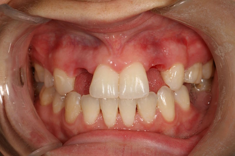 Before image of a mouth missing two teeth