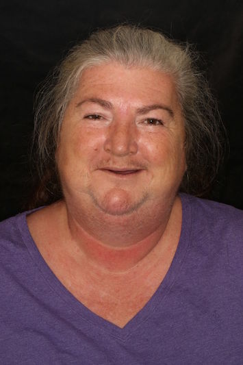 Before Image of a woman smiling, showing no teeth.