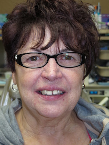 Before image of a woman with a gap between her front teeth